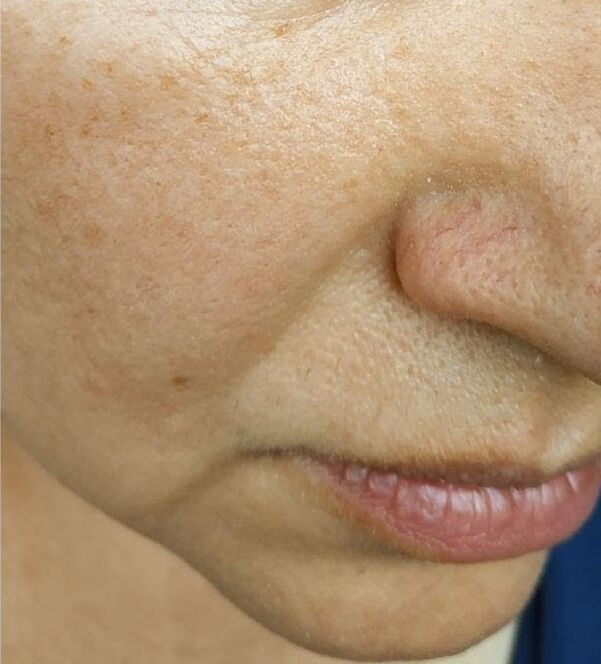 At age 40, nasolabial folds appear