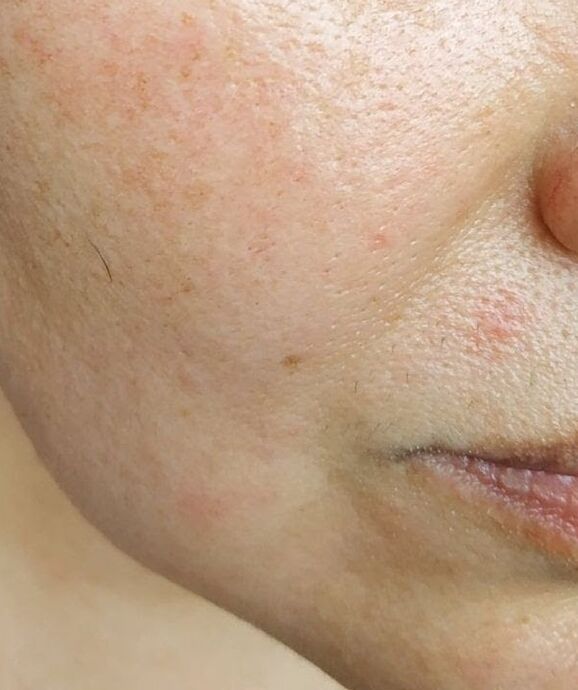 Intenskin has removed deep wrinkles in the nose