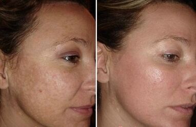 Before and after images of laser facial rejuvenation